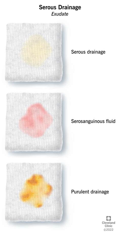 purulent drainage vs serous|What Exudates Tell You: Serous Exudates